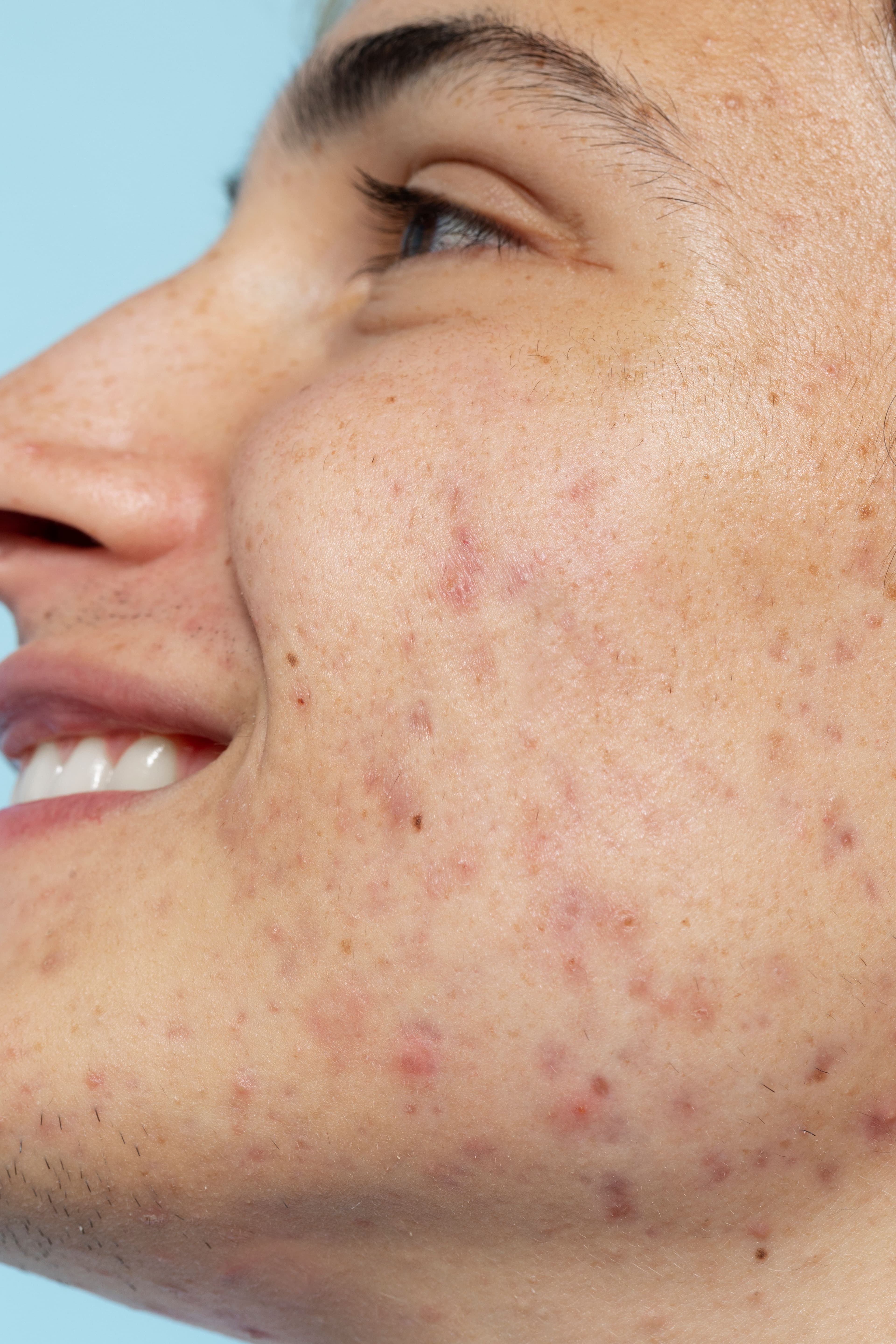Why Acne Forms: 4 Reasons and 2 Ways to Prevent It